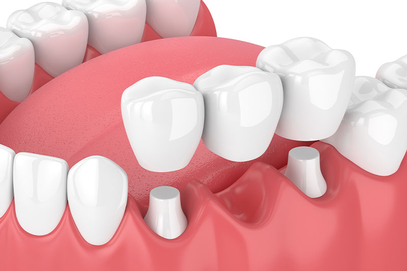 Dental Implants in Littleton