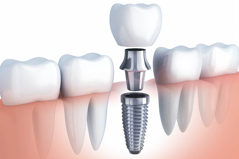 Dental Implant in Littleton