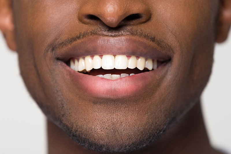 Dental Bonding in Littleton