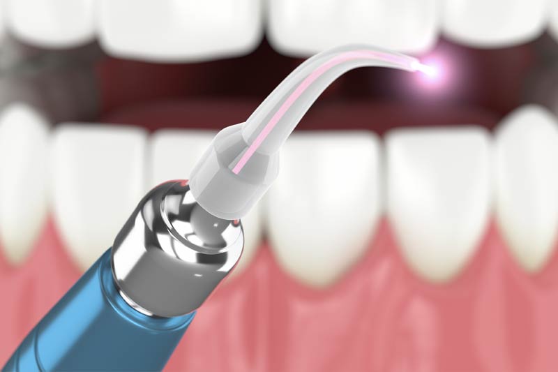 Diode Laser in Littleton