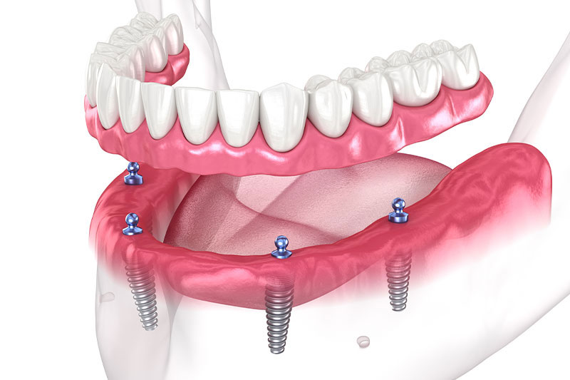Overdenture in Littleton
