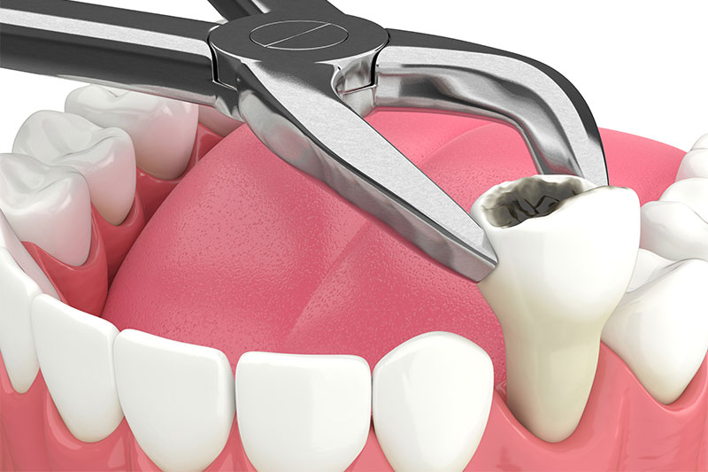 Tooth Extractions in Littleton