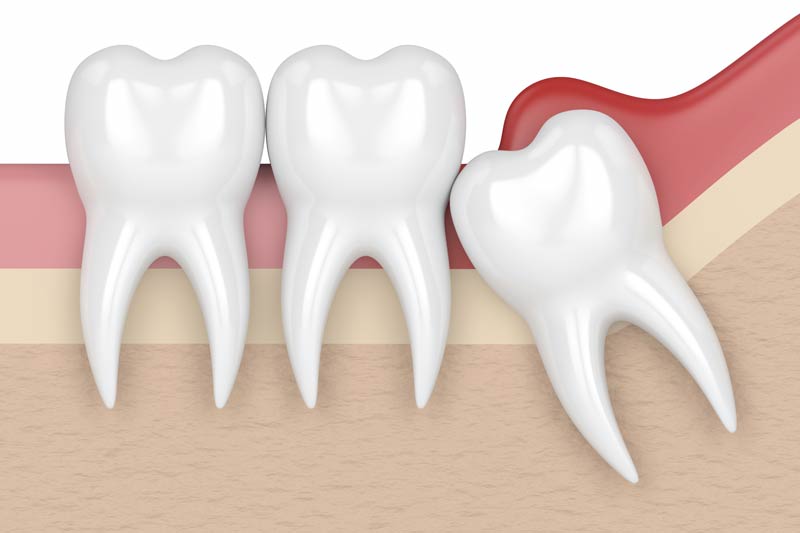 Wisdom Tooth Removal in Littleton