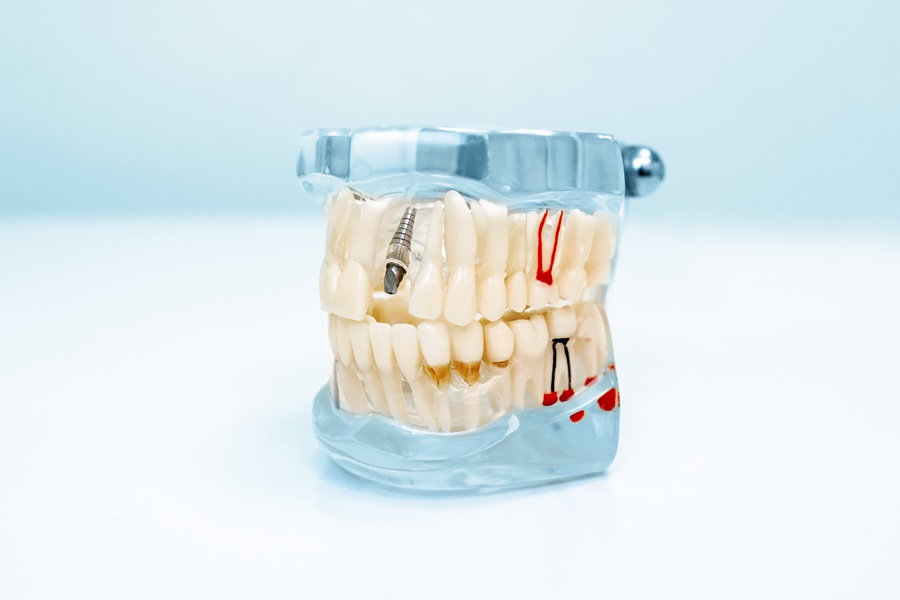 A Complete Step by Step Guide to Dental Implant