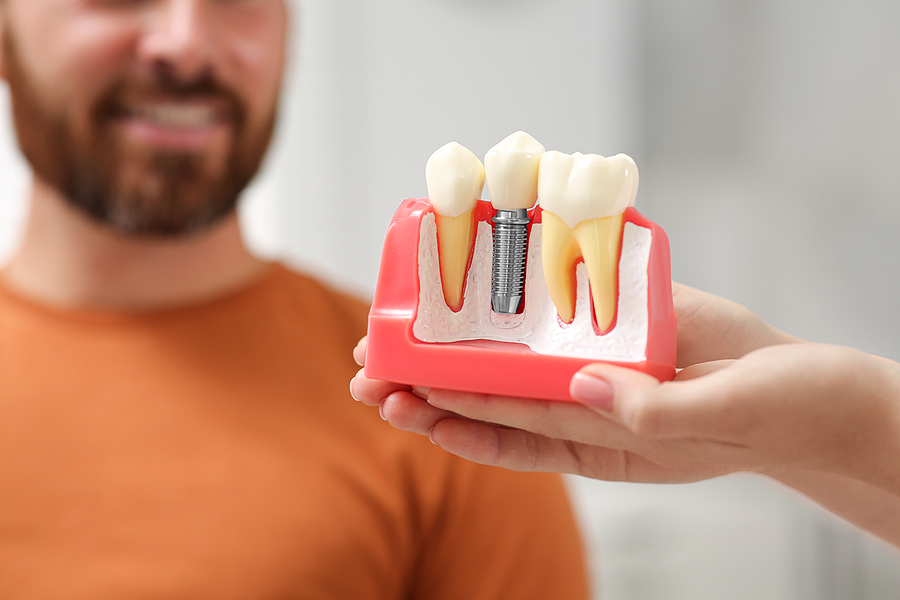 Top Benefits of Dental Implants