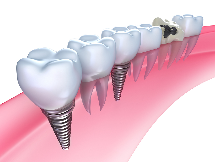 Achieving a Complete Smile with Dental Implants: Your Guide to Long-Lasting Tooth Replacement