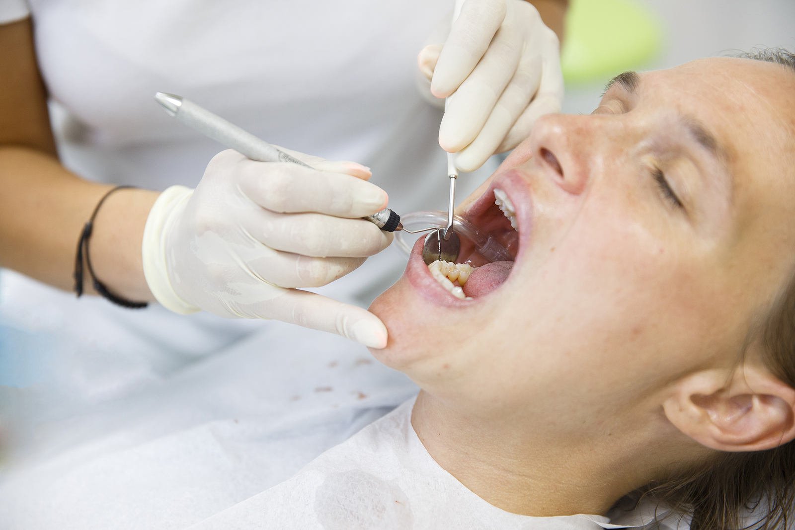How to Care for Your Mouth After a Tooth Extraction: Essential Tips for a Smooth Recovery
